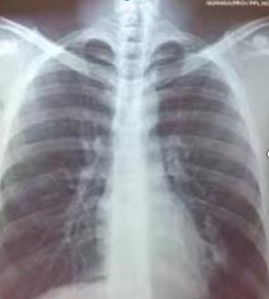提前预警“白肺”有方法